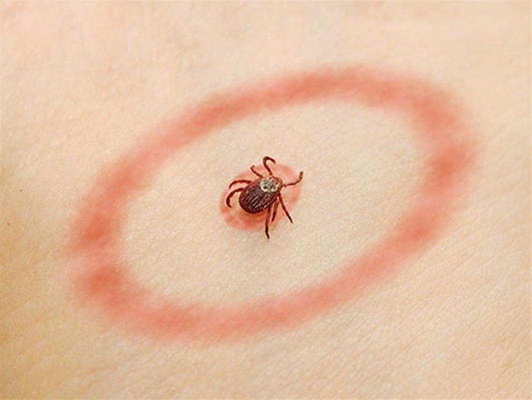 После укуса клеща житель Костромской области заболел иксодовым боррелиозом
